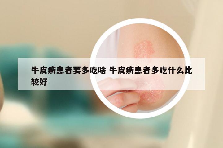 牛皮癣患者要多吃啥 牛皮癣患者多吃什么比较好