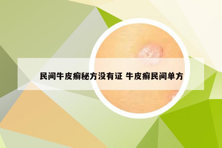 民间牛皮癣秘方没有证 牛皮癣民间单方