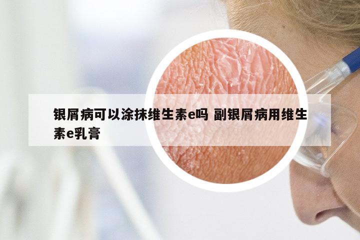 银屑病可以涂抹维生素e吗 副银屑病用维生素e乳膏