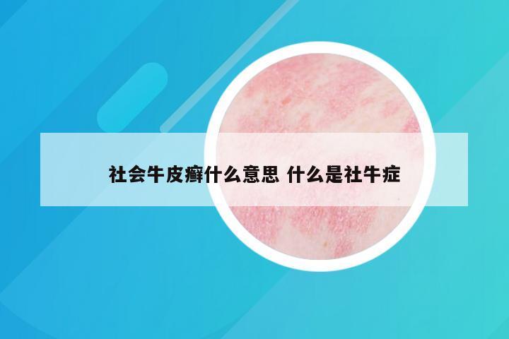 社会牛皮癣什么意思 什么是社牛症