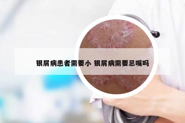 银屑病患者需要小 银屑病需要忌嘴吗