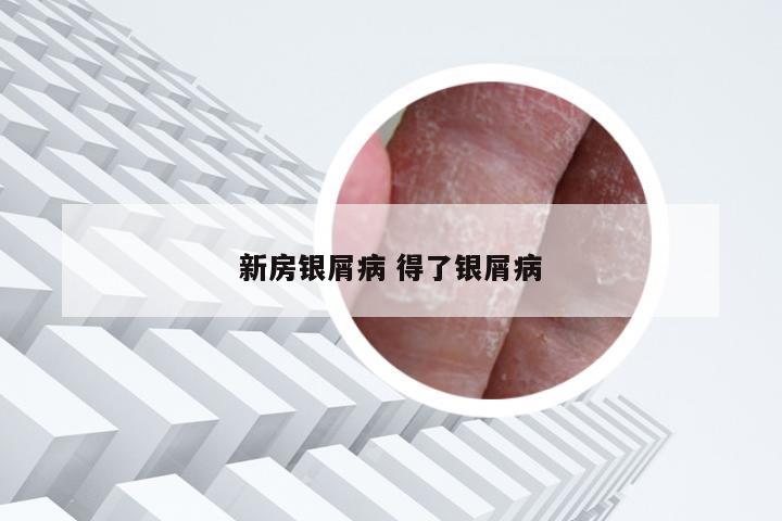新房银屑病 得了银屑病