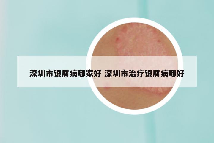 深圳市银屑病哪家好 深圳市治疗银屑病哪好