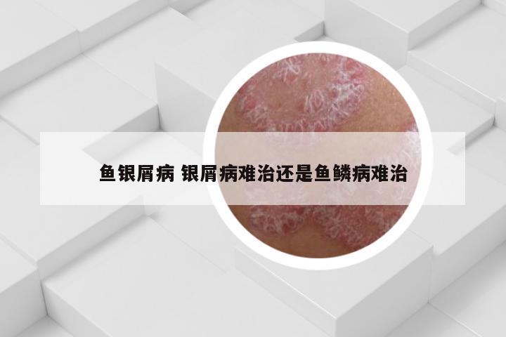 鱼银屑病 银屑病难治还是鱼鳞病难治