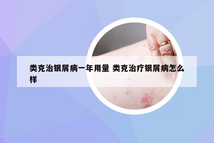 类克治银屑病一年用量 类克治疗银屑病怎么样