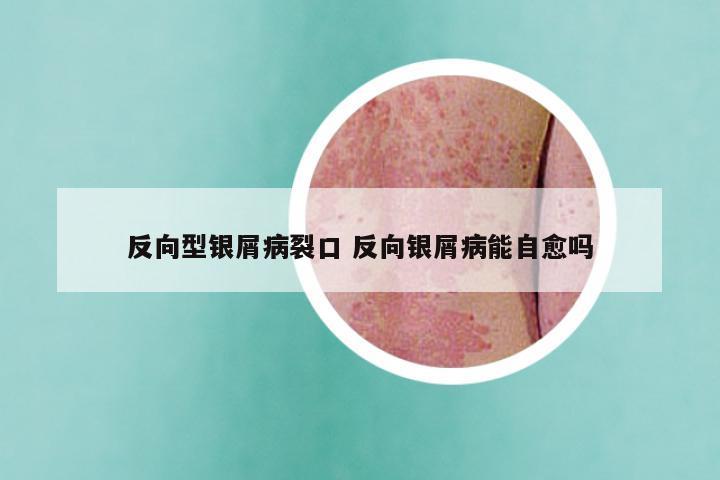 反向型银屑病裂口 反向银屑病能自愈吗