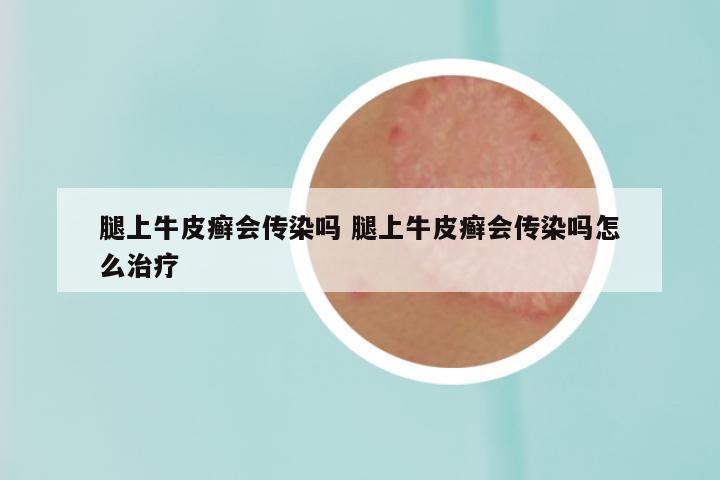 腿上牛皮癣会传染吗 腿上牛皮癣会传染吗怎么治疗