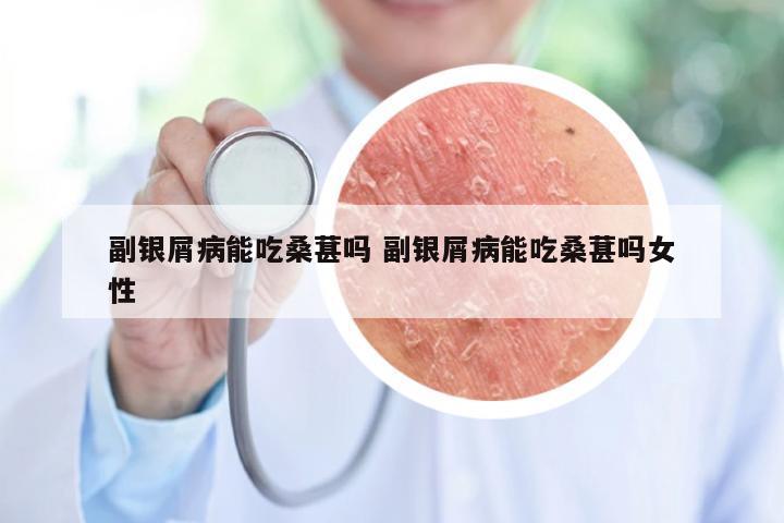 副银屑病能吃桑葚吗 副银屑病能吃桑葚吗女性