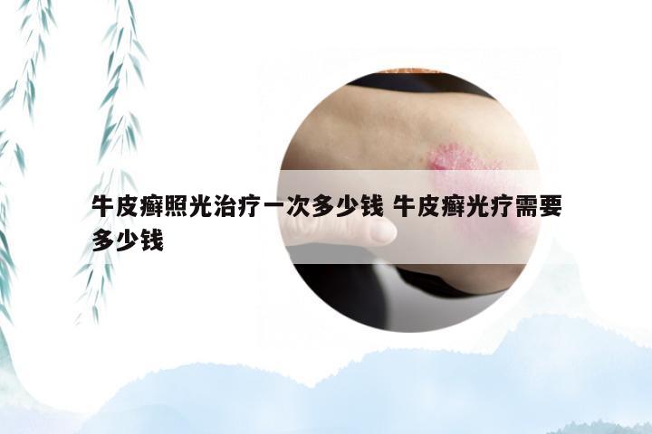 牛皮癣照光治疗一次多少钱 牛皮癣光疗需要多少钱