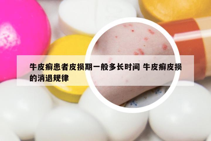 牛皮癣患者皮损期一般多长时间 牛皮癣皮损的消退规律