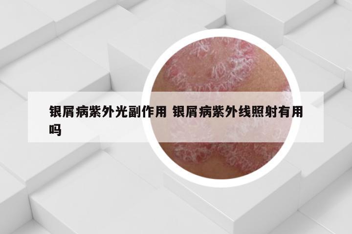 银屑病紫外光副作用 银屑病紫外线照射有用吗