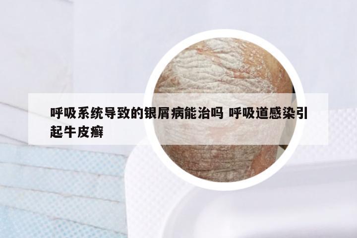 呼吸系统导致的银屑病能治吗 呼吸道感染引起牛皮癣