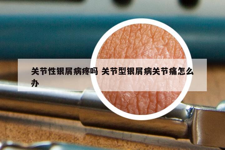 关节性银屑病疼吗 关节型银屑病关节痛怎么办