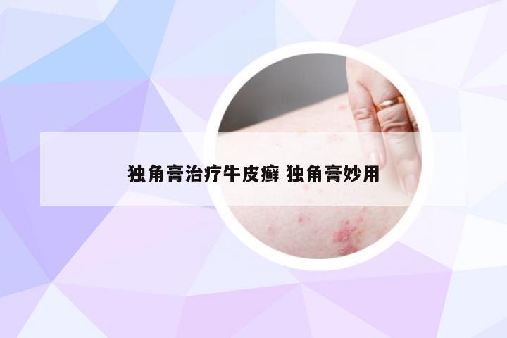 独角膏治疗牛皮癣 独角膏妙用