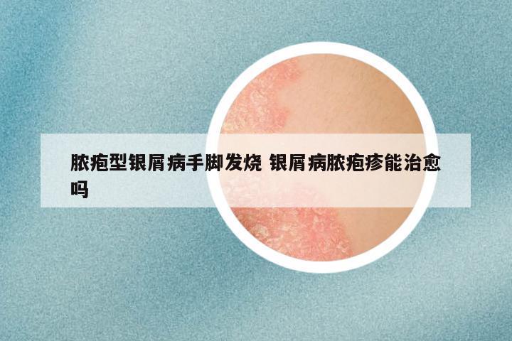 脓疱型银屑病手脚发烧 银屑病脓疱疹能治愈吗