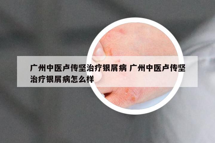 广州中医卢传坚治疗银屑病 广州中医卢传坚治疗银屑病怎么样