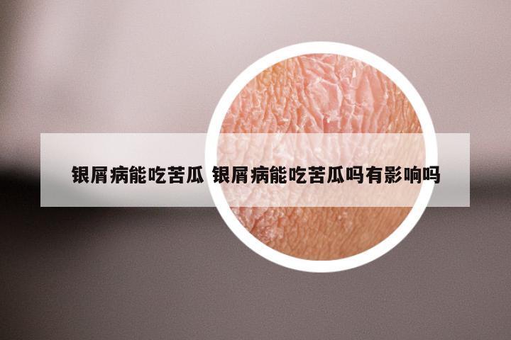 银屑病能吃苦瓜 银屑病能吃苦瓜吗有影响吗