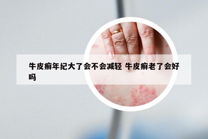 牛皮癣年纪大了会不会减轻 牛皮癣老了会好吗