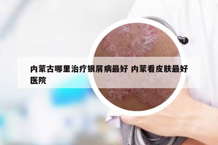 内蒙古哪里治疗银屑病最好 内蒙看皮肤最好医院