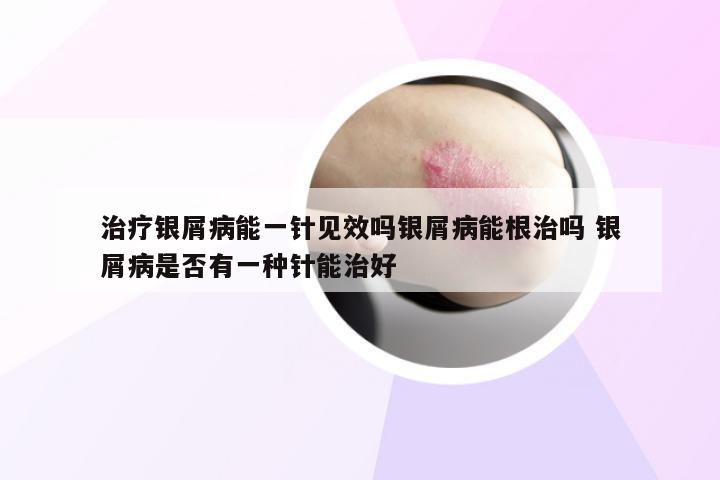 治疗银屑病能一针见效吗银屑病能根治吗 银屑病是否有一种针能治好
