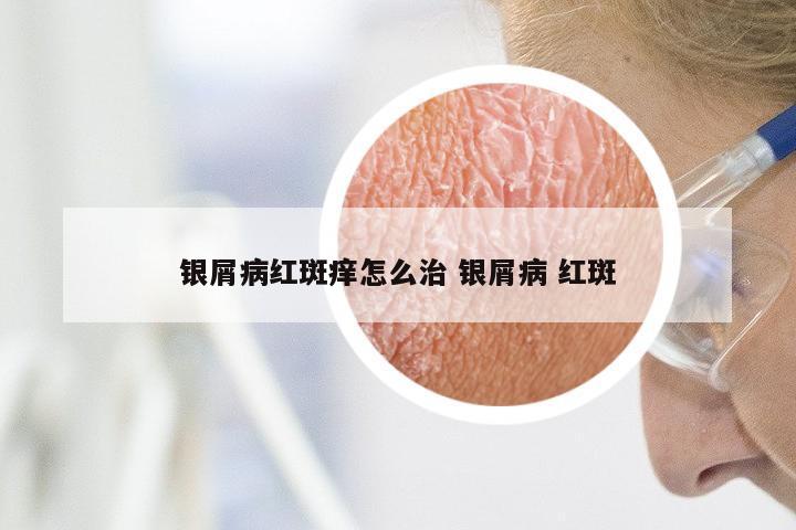 银屑病红斑痒怎么治 银屑病 红斑