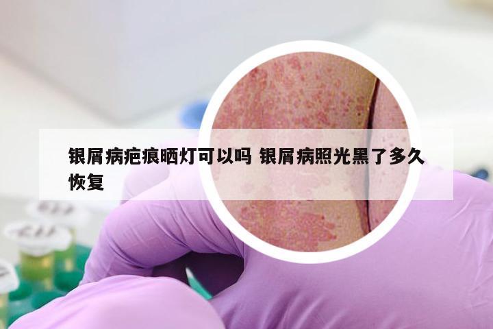银屑病疤痕晒灯可以吗 银屑病照光黑了多久恢复