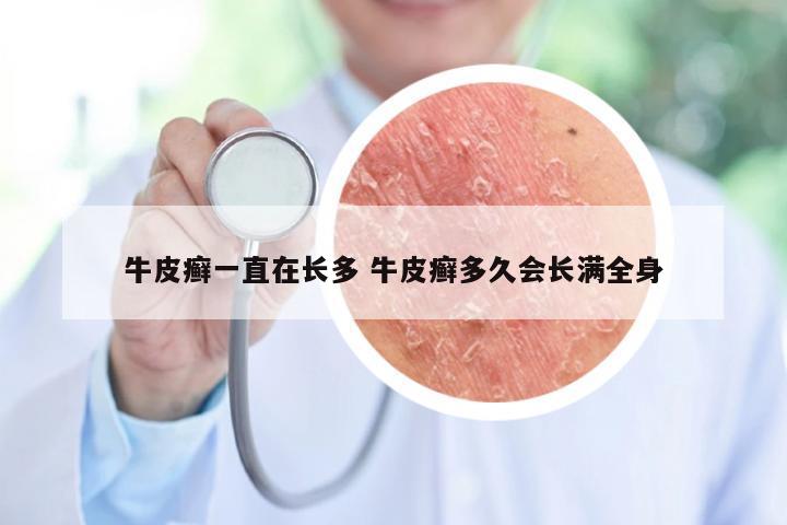 牛皮癣一直在长多 牛皮癣多久会长满全身