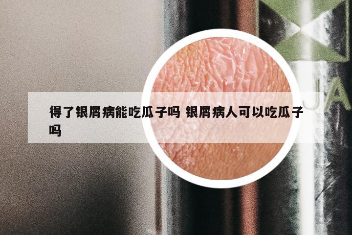 得了银屑病能吃瓜子吗 银屑病人可以吃瓜子吗