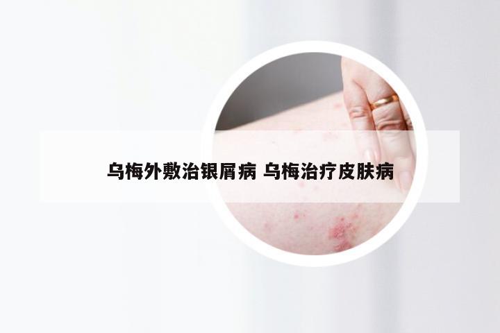 乌梅外敷治银屑病 乌梅治疗皮肤病