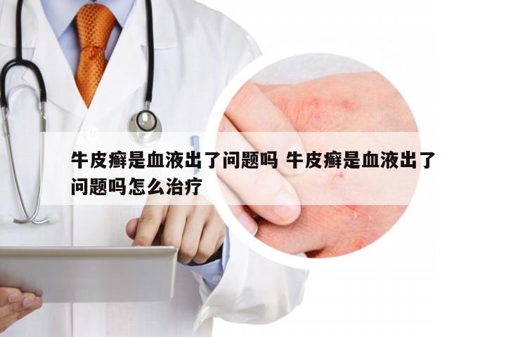 牛皮癣是血液出了问题吗 牛皮癣是血液出了问题吗怎么治疗