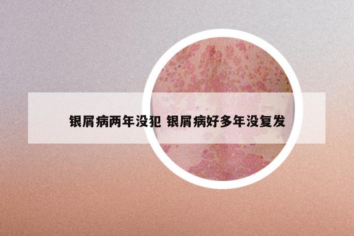 银屑病两年没犯 银屑病好多年没复发