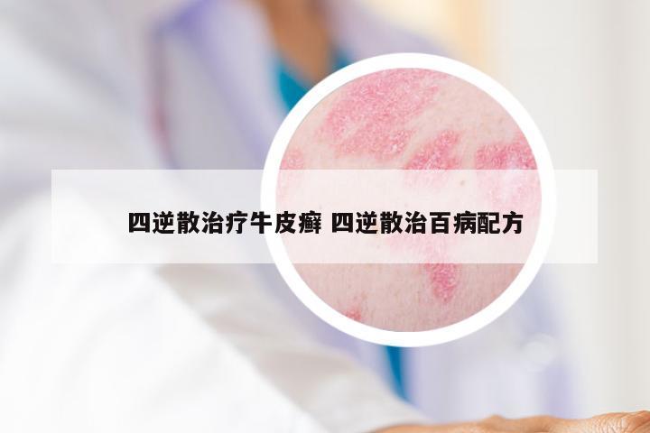 四逆散治疗牛皮癣 四逆散治百病配方