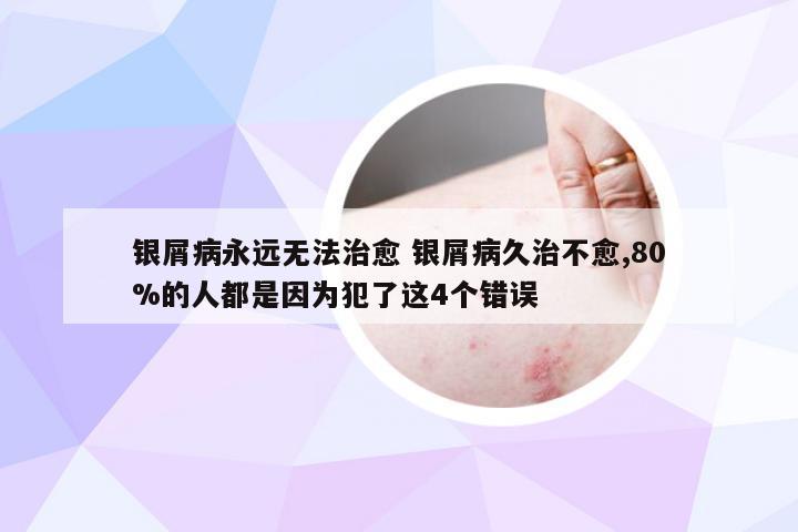 银屑病永远无法治愈 银屑病久治不愈,80%的人都是因为犯了这4个错误