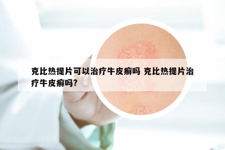 克比热提片可以治疗牛皮癣吗 克比热提片治疗牛皮癣吗?