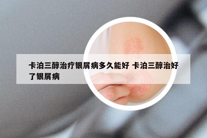 卡泊三醇治疗银屑病多久能好 卡泊三醇治好了银屑病