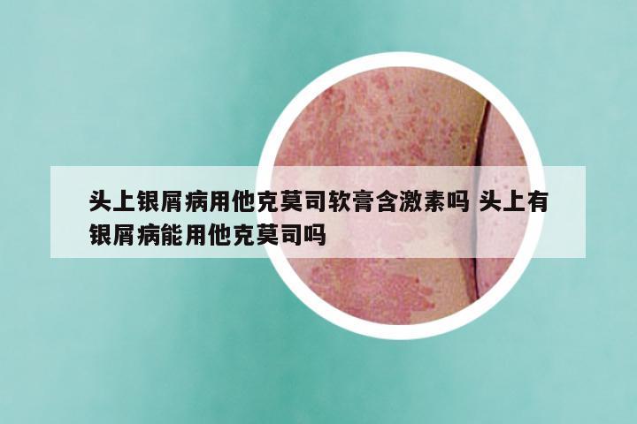 头上银屑病用他克莫司软膏含激素吗 头上有银屑病能用他克莫司吗