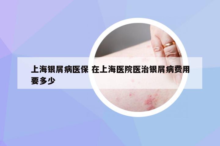 上海银屑病医保 在上海医院医治银屑病费用要多少