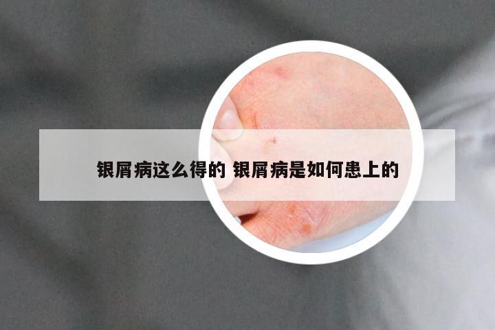 银屑病这么得的 银屑病是如何患上的