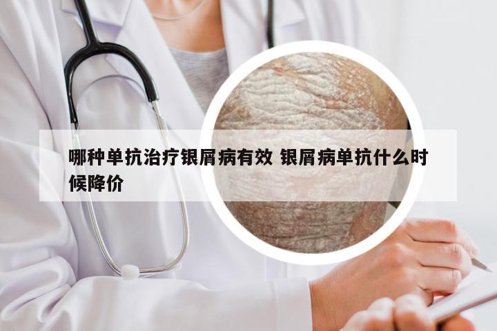 哪种单抗治疗银屑病有效 银屑病单抗什么时候降价
