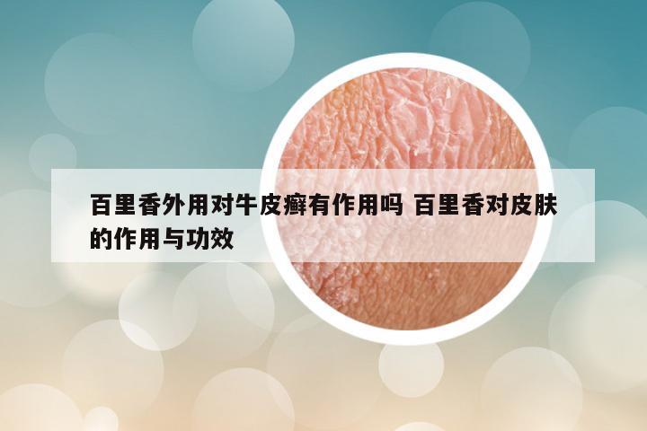 百里香外用对牛皮癣有作用吗 百里香对皮肤的作用与功效