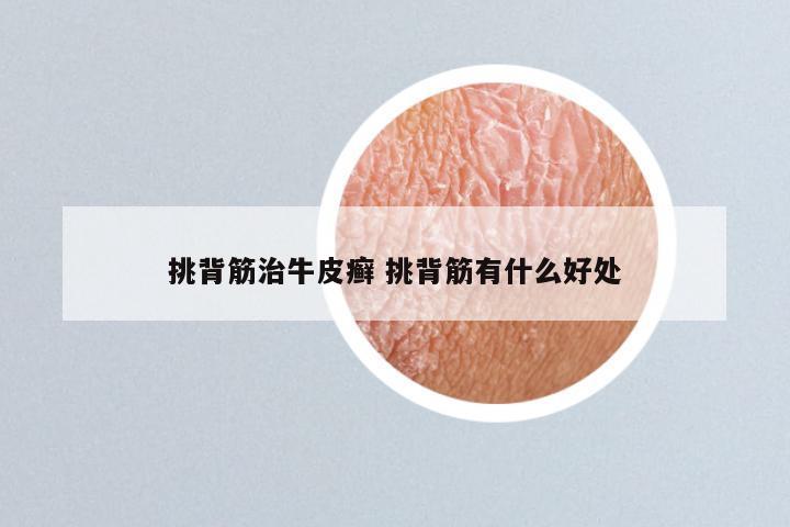 挑背筋治牛皮癣 挑背筋有什么好处