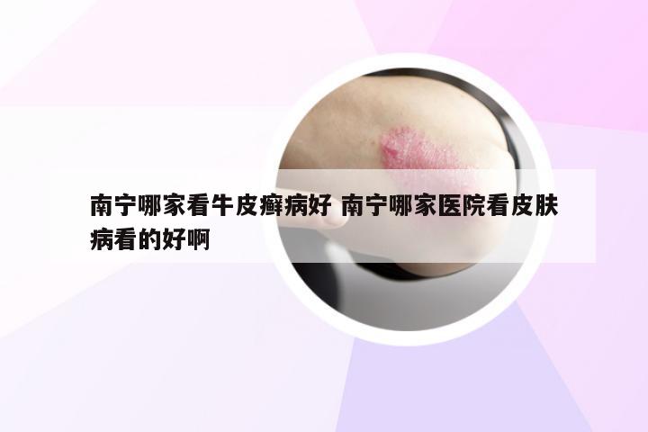 南宁哪家看牛皮癣病好 南宁哪家医院看皮肤病看的好啊