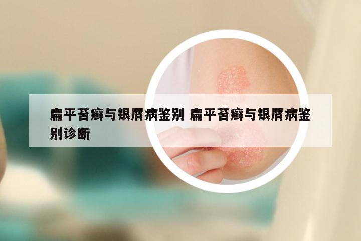 扁平苔癣与银屑病鉴别 扁平苔癣与银屑病鉴别诊断