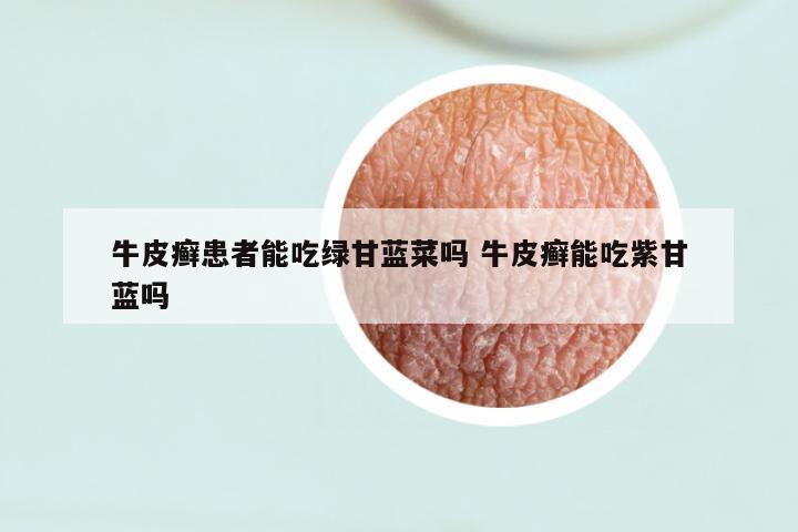 牛皮癣患者能吃绿甘蓝菜吗 牛皮癣能吃紫甘蓝吗
