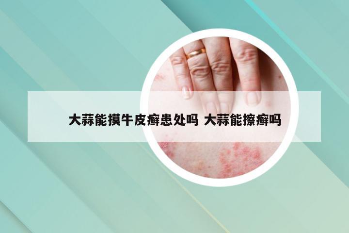 大蒜能摸牛皮癣患处吗 大蒜能擦癣吗
