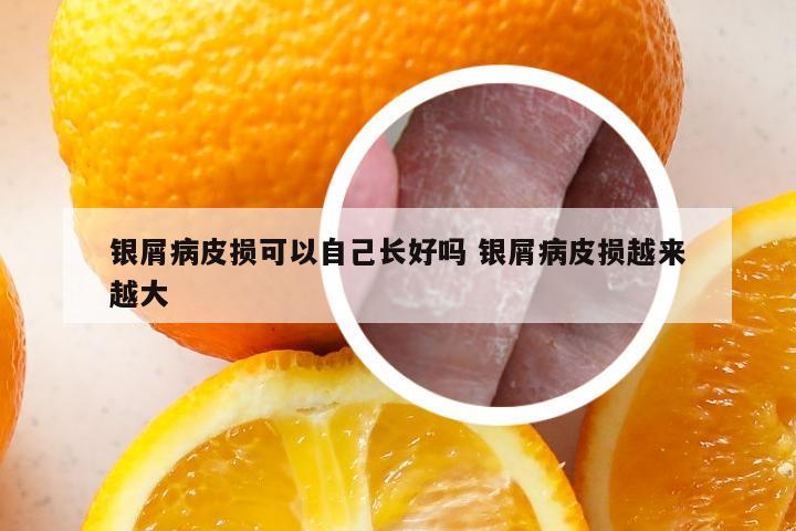 银屑病皮损可以自己长好吗 银屑病皮损越来越大