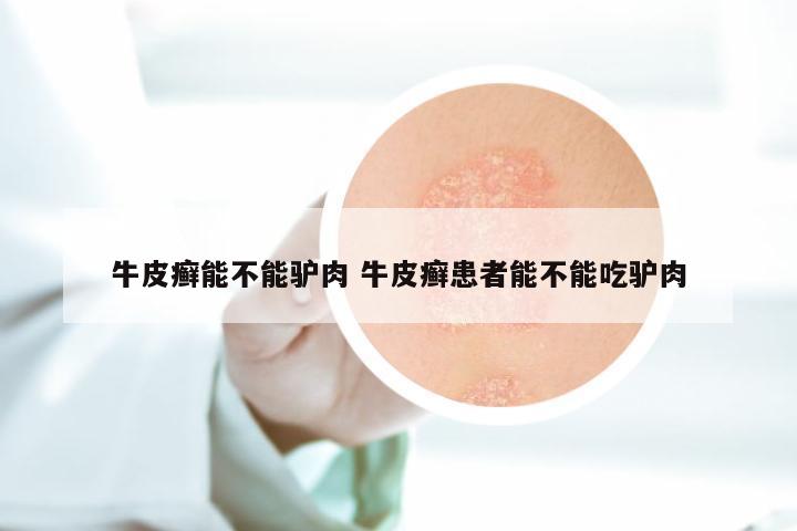 牛皮癣能不能驴肉 牛皮癣患者能不能吃驴肉