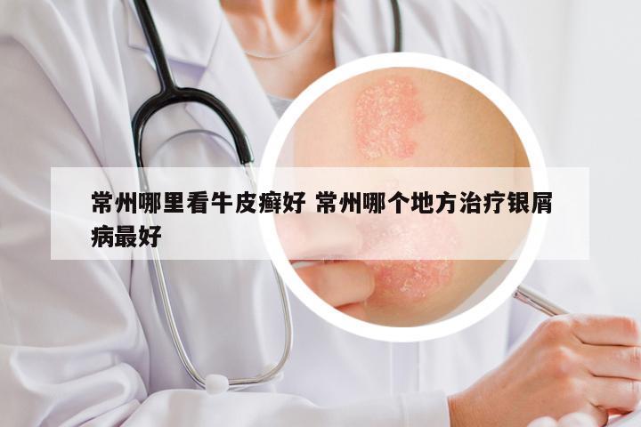 常州哪里看牛皮癣好 常州哪个地方治疗银屑病最好