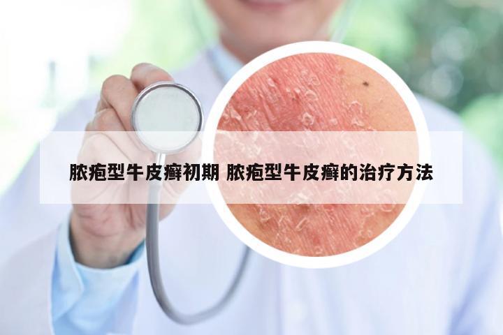 脓疱型牛皮癣初期 脓疱型牛皮癣的治疗方法