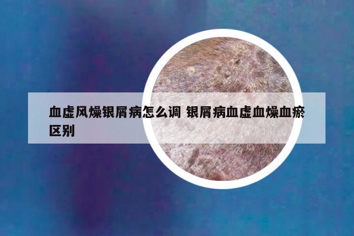 血虚风燥银屑病怎么调 银屑病血虚血燥血瘀区别